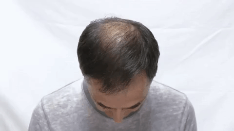 Description Picture 2 of itemHair growth solution can quickly and effectively grow hair, repair hereditary hair loss, postpartum hair loss, and seborrheic al