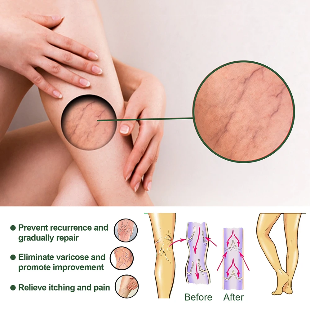 

Massage Soap For Treatment Of Leg Varicose Veins Prepared From Natural Wormwood And Ginger Extracts Helps Relieve Discomfort