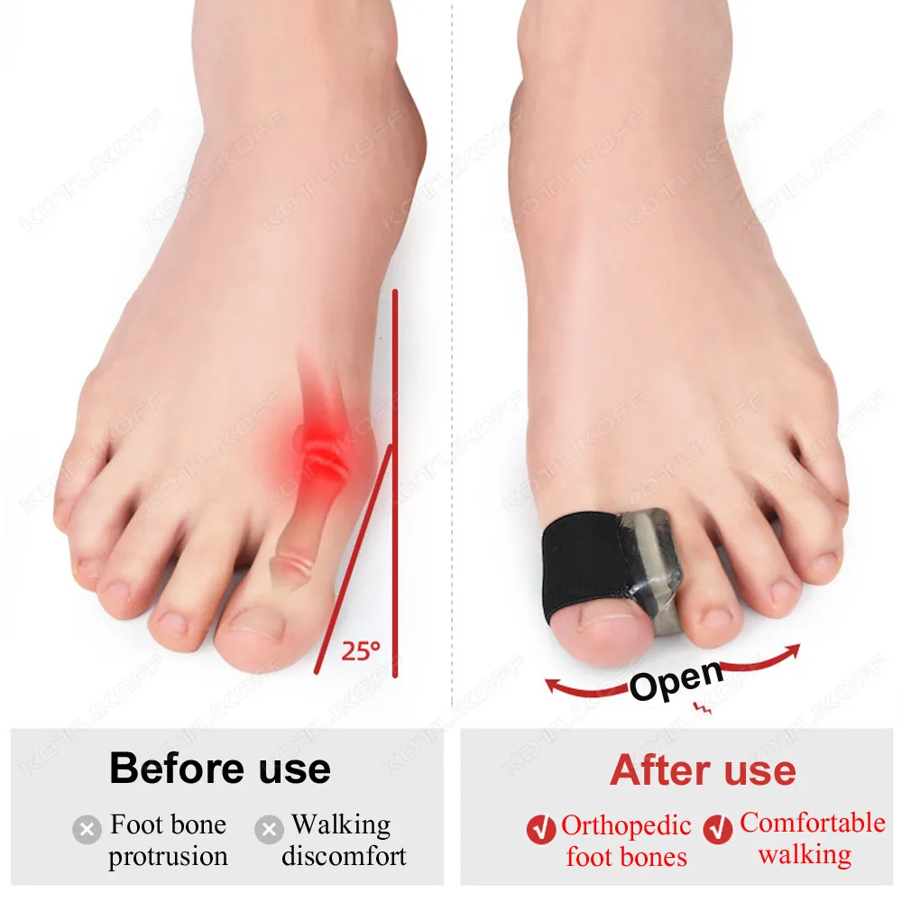 Gel Toe Separator Hallux Valgus Bunion Corrector Straightener Feet Bone Thumb Adjuster Correction Spacer Foot Care Tool 1 Pair