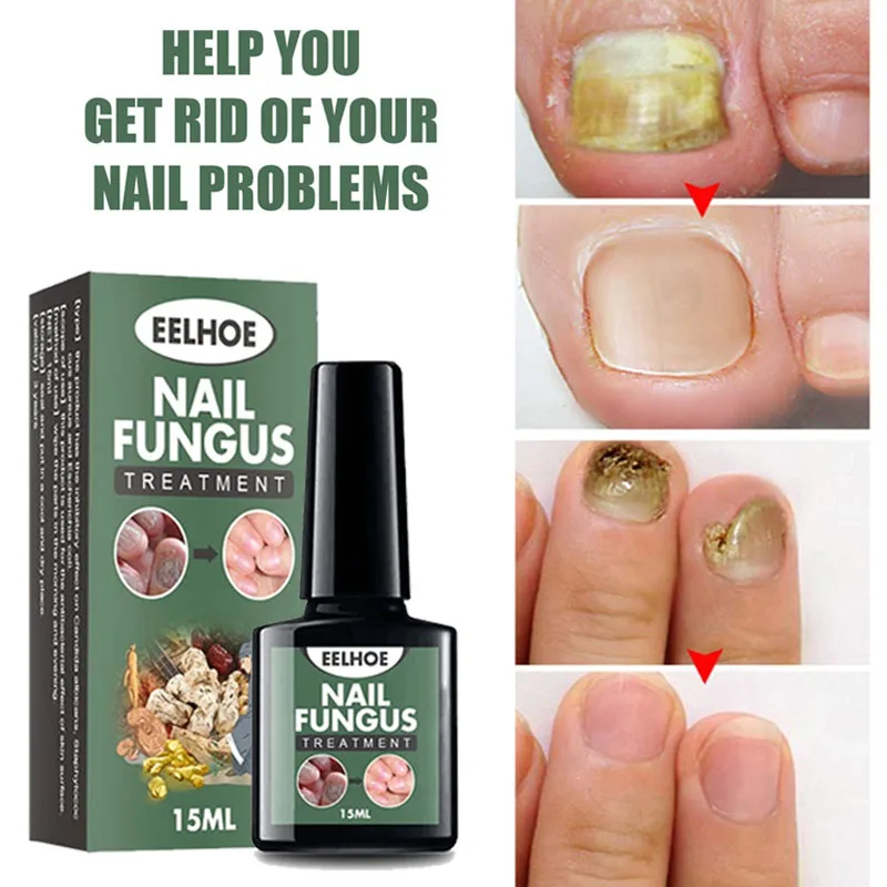 Nail Fungal Treatment Feet Care Liquid Anti Infection Paronychia