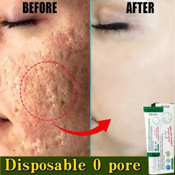 Crema restringente i pori Prodotto per la riparazione del pozzo dell'acne per uomini e donne Rimuovi la cicatrice della stampa dell'acne Crema per la pelle liscia antinfiammatoria dei pori grandi 1