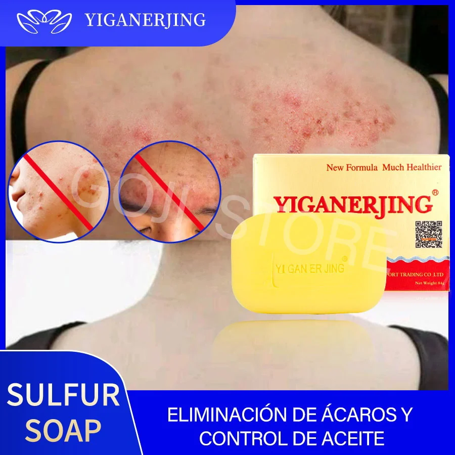 marco equivocado enero Jabón de azufre Yiganerjing para el acné, tratamiento de Psoriasis Eczema,  alivia la picazón de la piel natural, baño limpio para toda la piel, jabón  antibacteriano 84g - AliExpress Belleza y salud