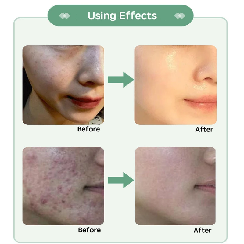 Facial Cream 70% Pure Natural Sponge Microcryst Freeze-dried Powder Repair Acne Clean Follicles Remove Blackheads Seaweed Bone Plant Cream