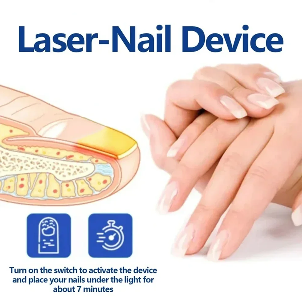 Traitement universel des mycoses des pieds et des ongles par stylo laser : élimination des mycoses des ongles, onychomycose, panaris et soins réparateurs._voghion.com