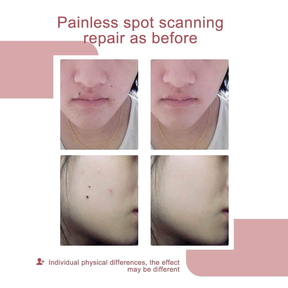 Professional Plasma Pen Eyelid Lifting Beauty Anti-Wrinkle Skin Lifting Electric Black Spot Skin Tags Moles Remove Beauty Care