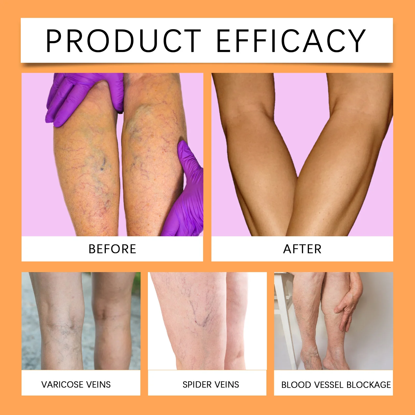 Varicose Veins Patch 12PCS/Bag Unisex Varicose Veins Treatment Patch Legs Sore Swelling Plaster Promote Metabolism Promote Smooth Blood Circulation