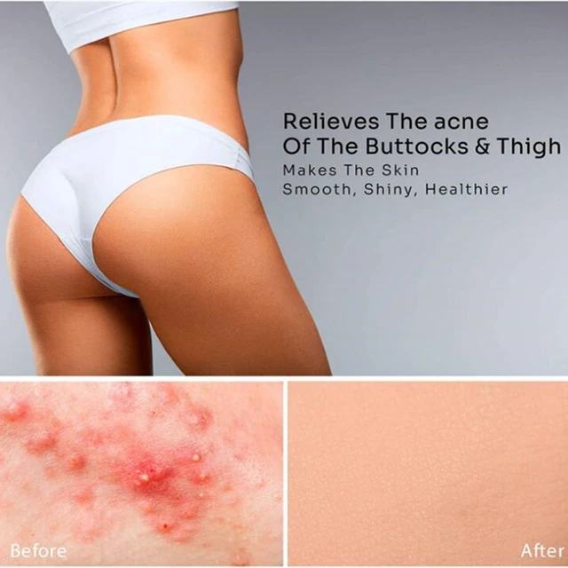 How to Treat Pimples on Your Butt: Your Ultimate Guide to Clear Skin