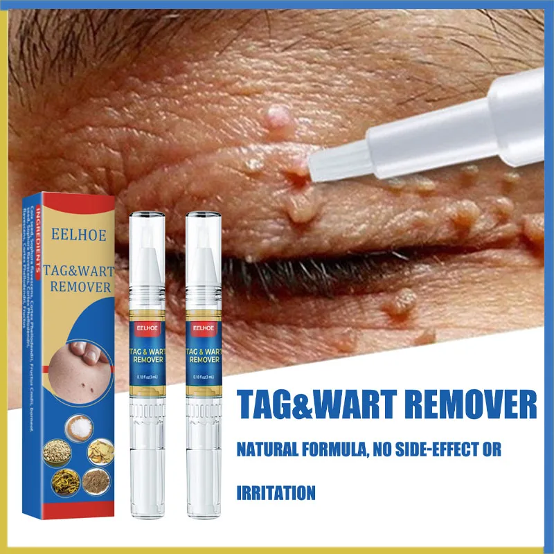 2pcs Wart Removal Pen Mole Skin Tag Treatment Essence Remove Skin