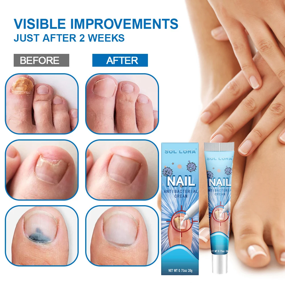 Fungal Nail Treatment Cream Fast Repair Nail Fungus Removal Laser Device Anti Infection Onychomycosis Toenail Fingernail Care