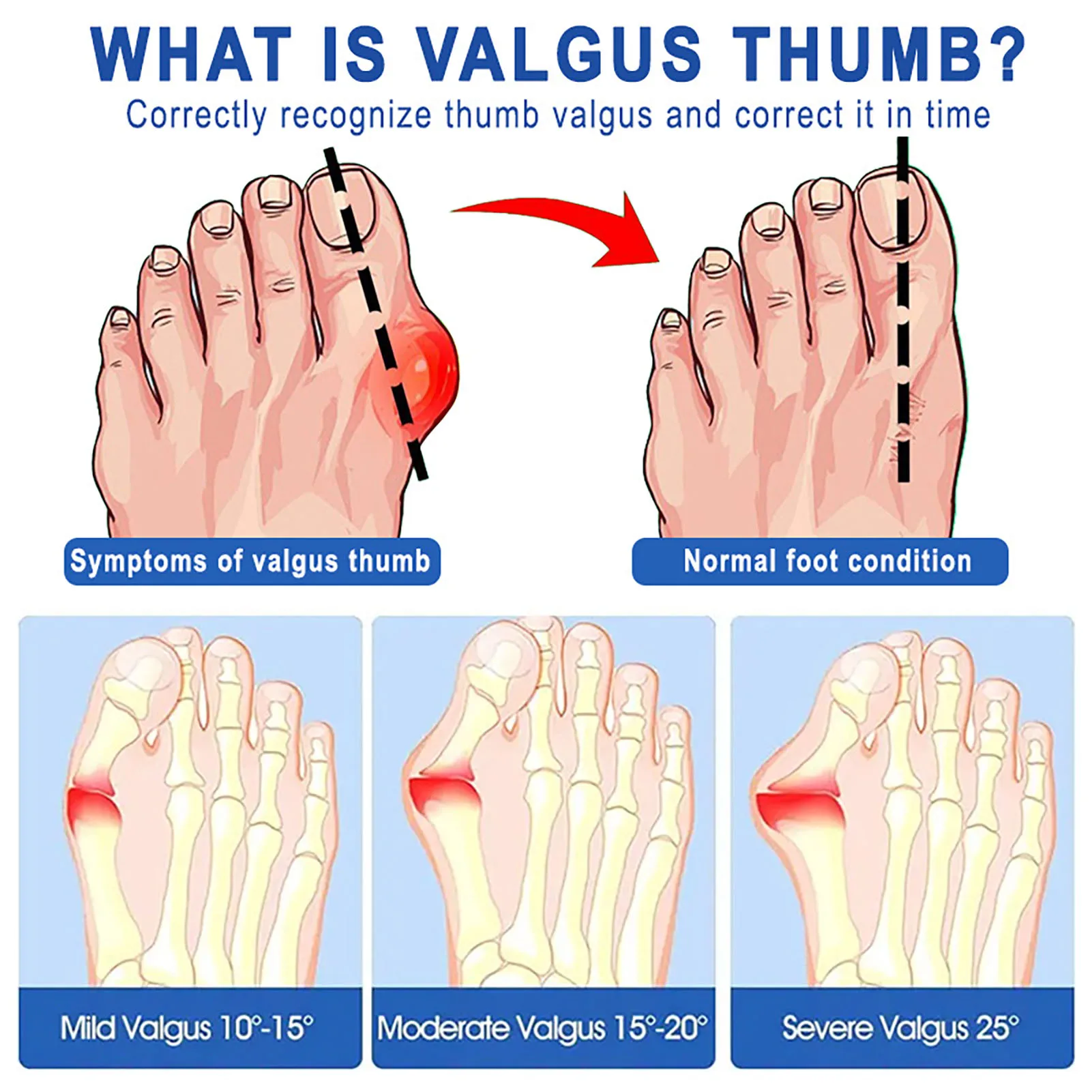 24pcs Gout Treatment Pain Relief Patch for Limb Stiffness Toe Finger Bunion Hallux Valgus Corrector Patch Arthritis Joint Foot Care hallux valgus toe corrector,wormwood pain relief patch