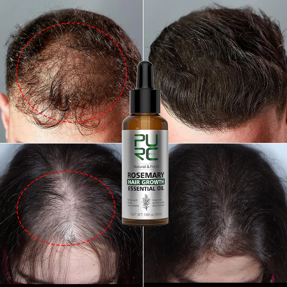 

PURC Rosemary Oil Hair Growth Products Anti Hair Loss Fast Regrowth Essence Scalp Treatment Oils for Men Women Hair Care