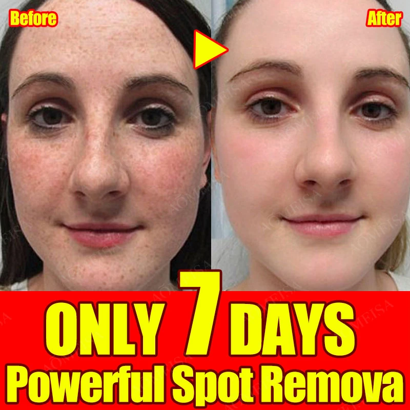 Spot Whitening Serum Brightening Lightening Hyperpigmentation Chloasma