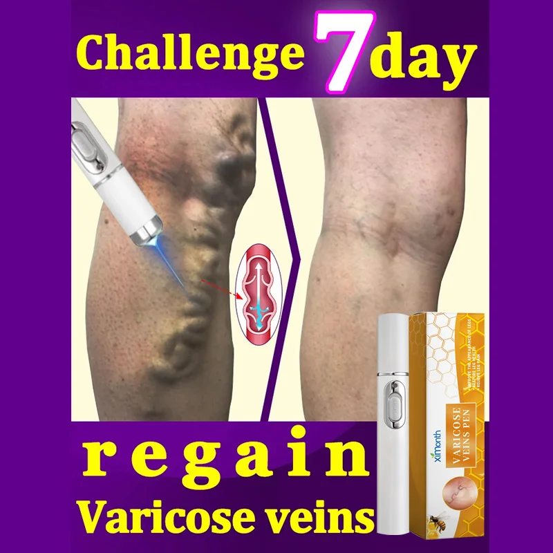 Laser Treatment Varicose Vein Ointment Lampshade Therapy Varicose Veins Legs Relief Dilated Vasculitis Phlebitis Blood Circulation