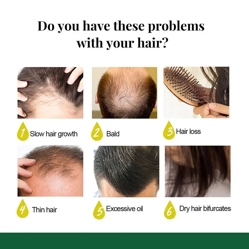 

Эссенция для роста волос Sdatter, новое масло для роста волос, натуральное средство для лечения выпадения волос, эффективное быстрое лечение кожи головы