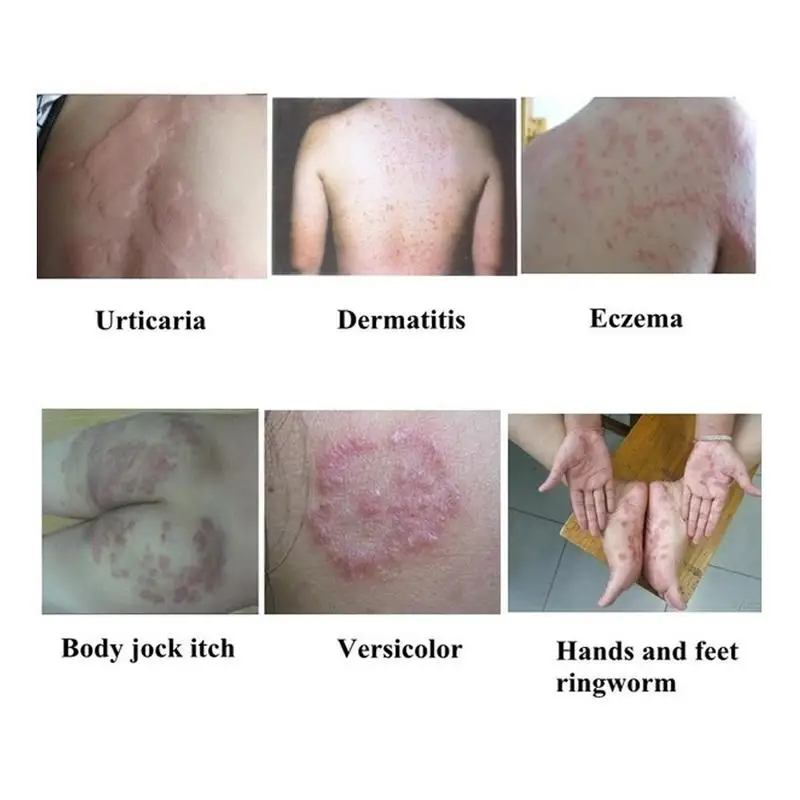 Antibacterial Psoriasis Cream Herbal Effective Anti-itch Relief Dermatitis Eczema Treatment Urticaria Desquamation Skin Care