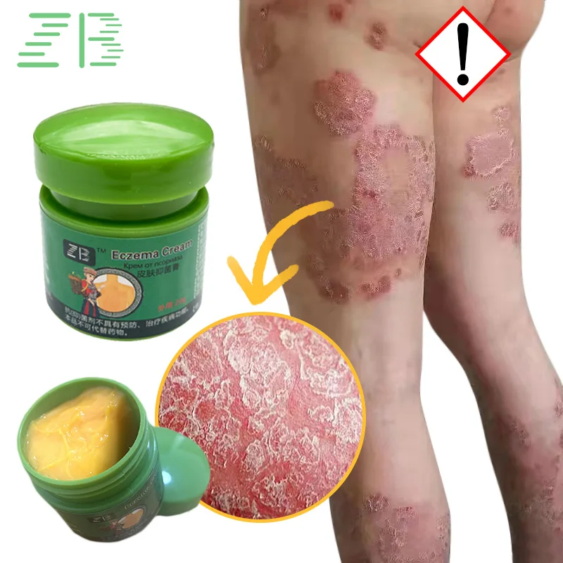 

20g Herbal Psoriasis Treatment Cream Antibacterial Anti-itch Dermatiti Eczema Urticaria Alergy Skin Ointment Body Health Care