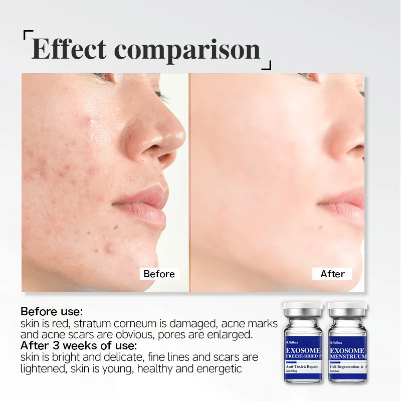 EGF Exosome Serum Lyophilized Stem Cell Therapy Scar Healing Acne Anti-inflammatory Anti-aging