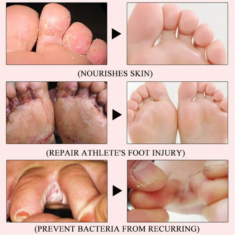 Nail Fungus Remover Pain Analgesic Cream Anti Fungal Spray Foot Fungus Cream For Cracked Heel Peeling Blister Repairing Feet
