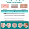 Ultra Fine No 5 Cell Pimples Black Head Clip Tweezers Beauty Salon Special Scraping Closing Artifact Acne Needle Tool 3