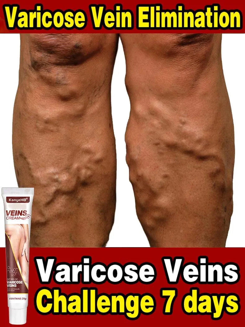 

Effective Varicose Veins Cream Relieve Vasculitis Phlebitis Spider Pain Relief Ointment Herb Plaster Beauty Body Care