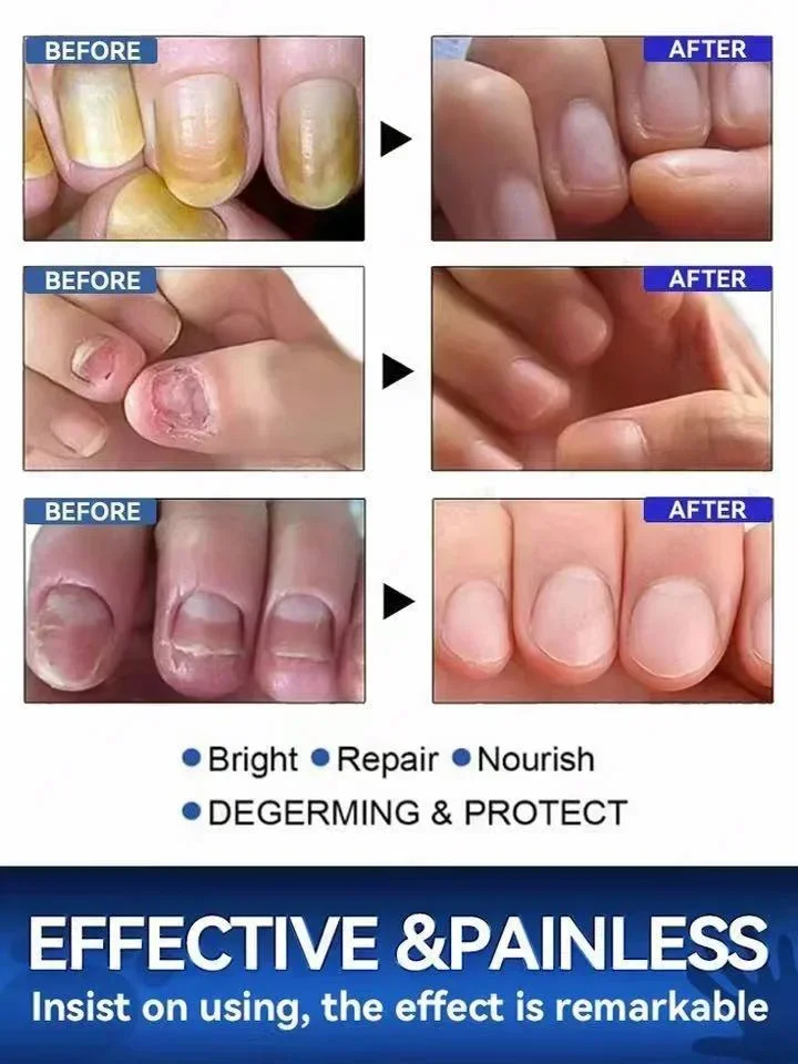 Laser Product To Solves Nail troubles nail laser