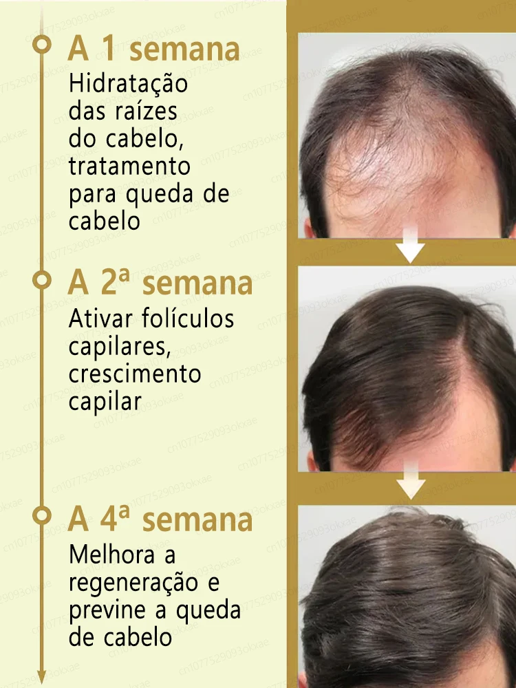 Óleo essencial anti-alopecia para o crescimento rápido do cabelo, soro gengibre
