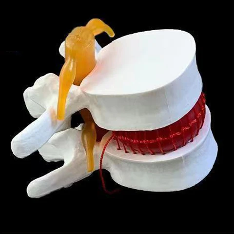 

2Kinds Of Medical Props Model Anatomical Spine Lumbar Disc Herniation Anatomy Medical Teaching Tool Kit Supplies For School Use