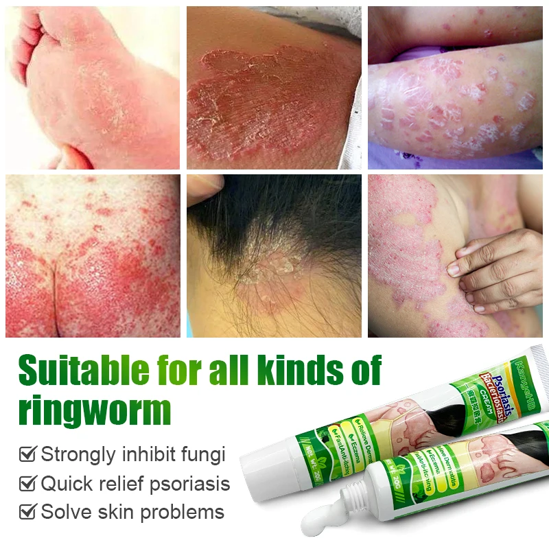 1pcs Private Part Anti-itch Cream Anal Itching Cream Psoriasis Glans Penis Itch Scrotal Eczema Odor Antifungal G024