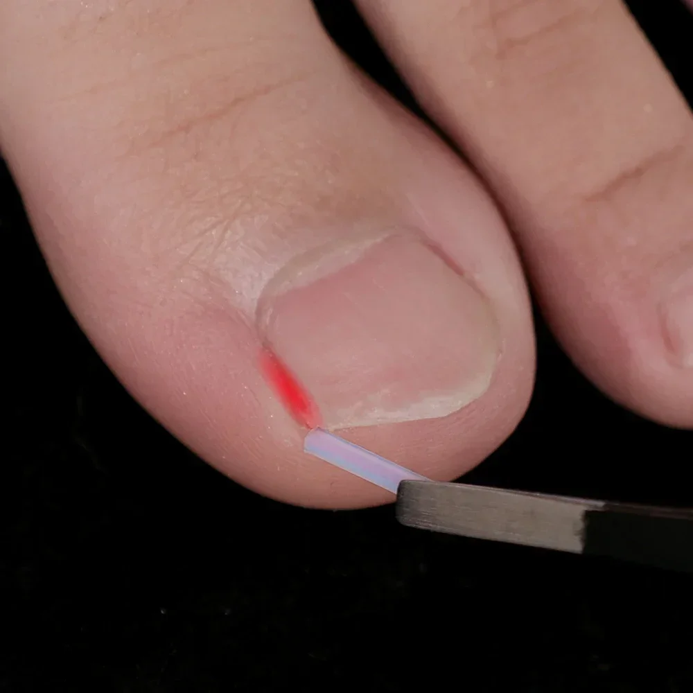 Ingrown Toenail Correction Tool Plastic Foot Care