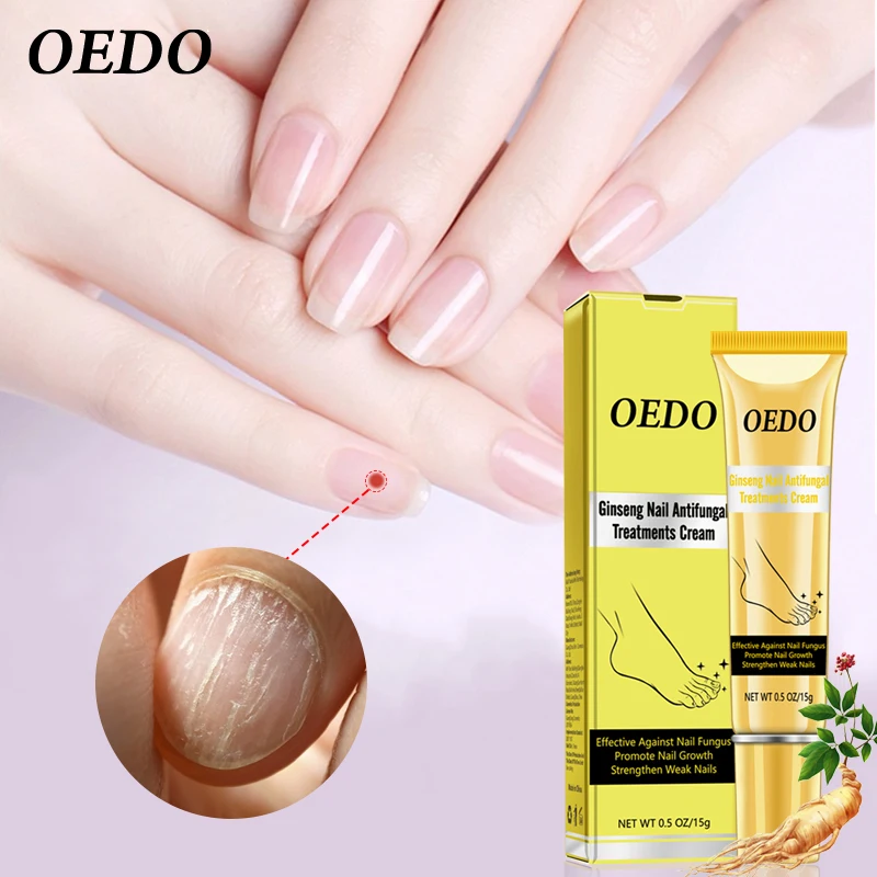 

Nail Repair Cream Repair Damaged Nails Prevent Paronychia Prevent Fungal Infection Manicure Nail Care Healthy Nails BeautyHealth