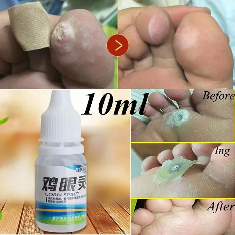 Powerful Foot Corn Callus Remover 10ml Pro nail problem solving white hair remover foot callus remover wrinkle remover