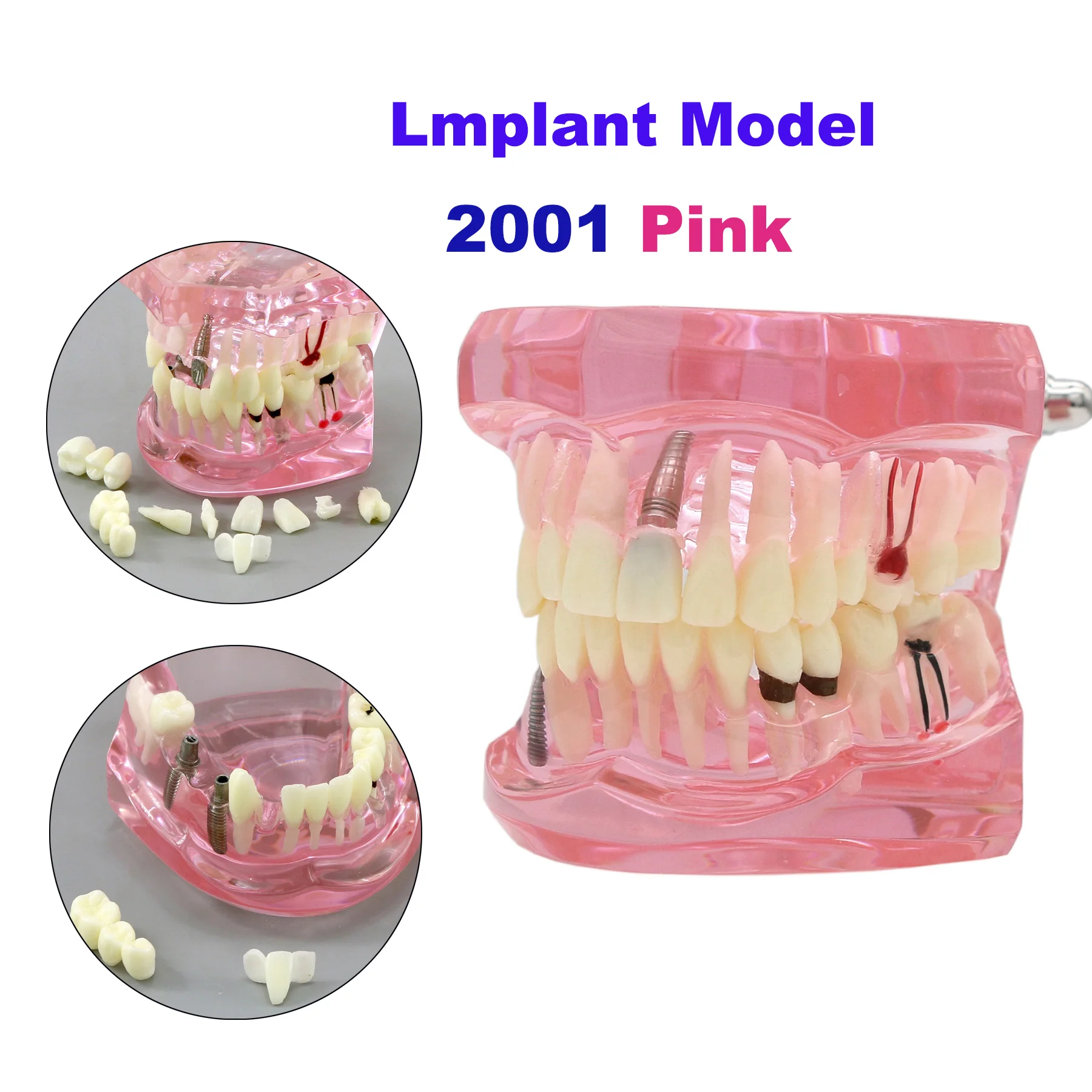 

Dental Teeth Model Teaching Model Implant Disease Teeth Repair Restoration Bridge for Dentist Teaching Studying Demo M2001 Pink.