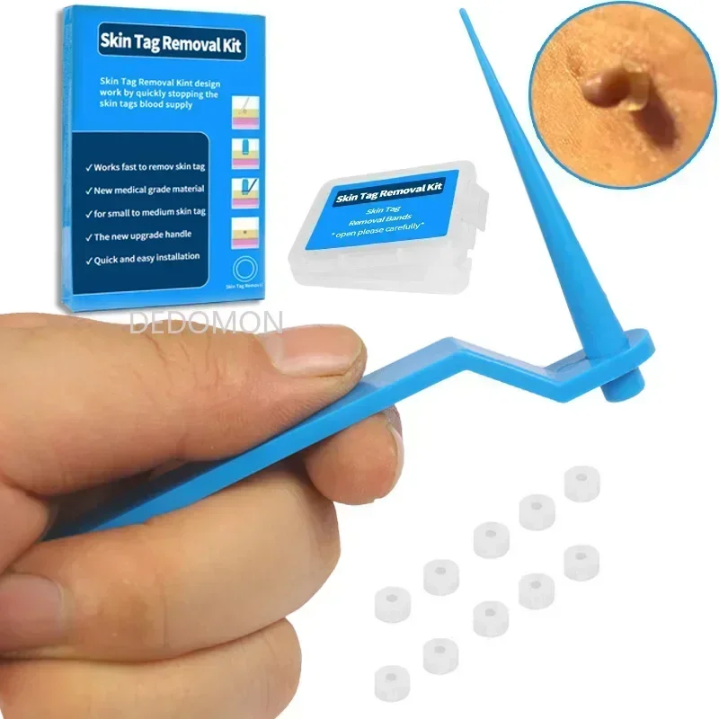 Skin Tag Removal Tool Kit Mole Wart Remover Micro Band Treatment Cleansing Swabs