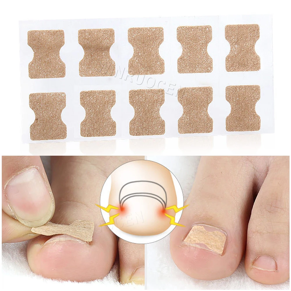 

10pcs/set Professional Ingrown Toenail Correction Tool Embedded Toe Nail Corrector Elastic Patch Sticker Pedicure Tool