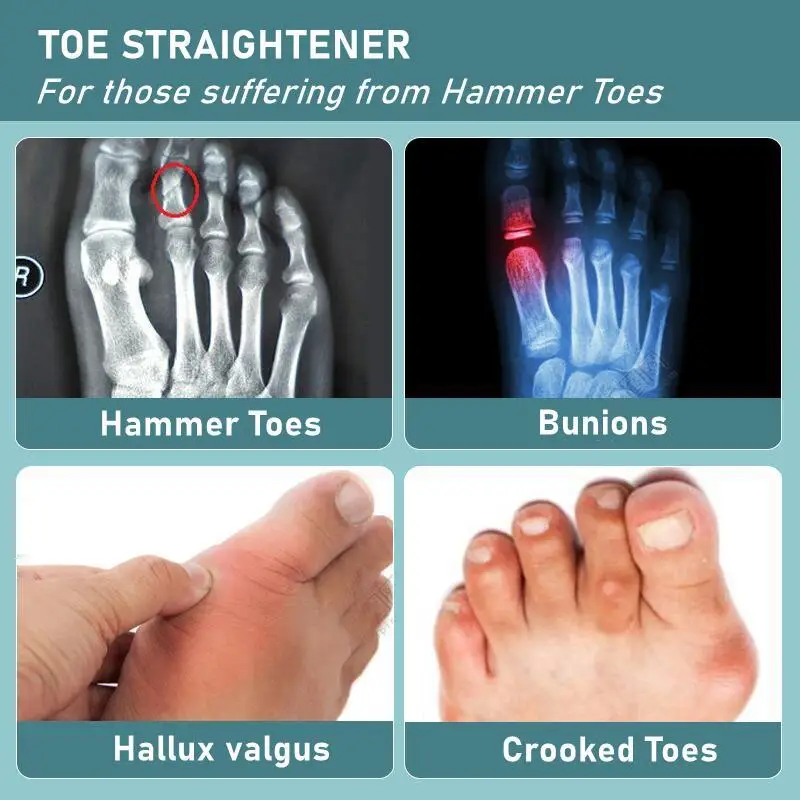 Hammer Toe Straightener Adjustable Hammer Toe Straightener and Corrector Metatarsalgia Claw Toe Mallet Pain Relief Splint Foot Compression Wrap