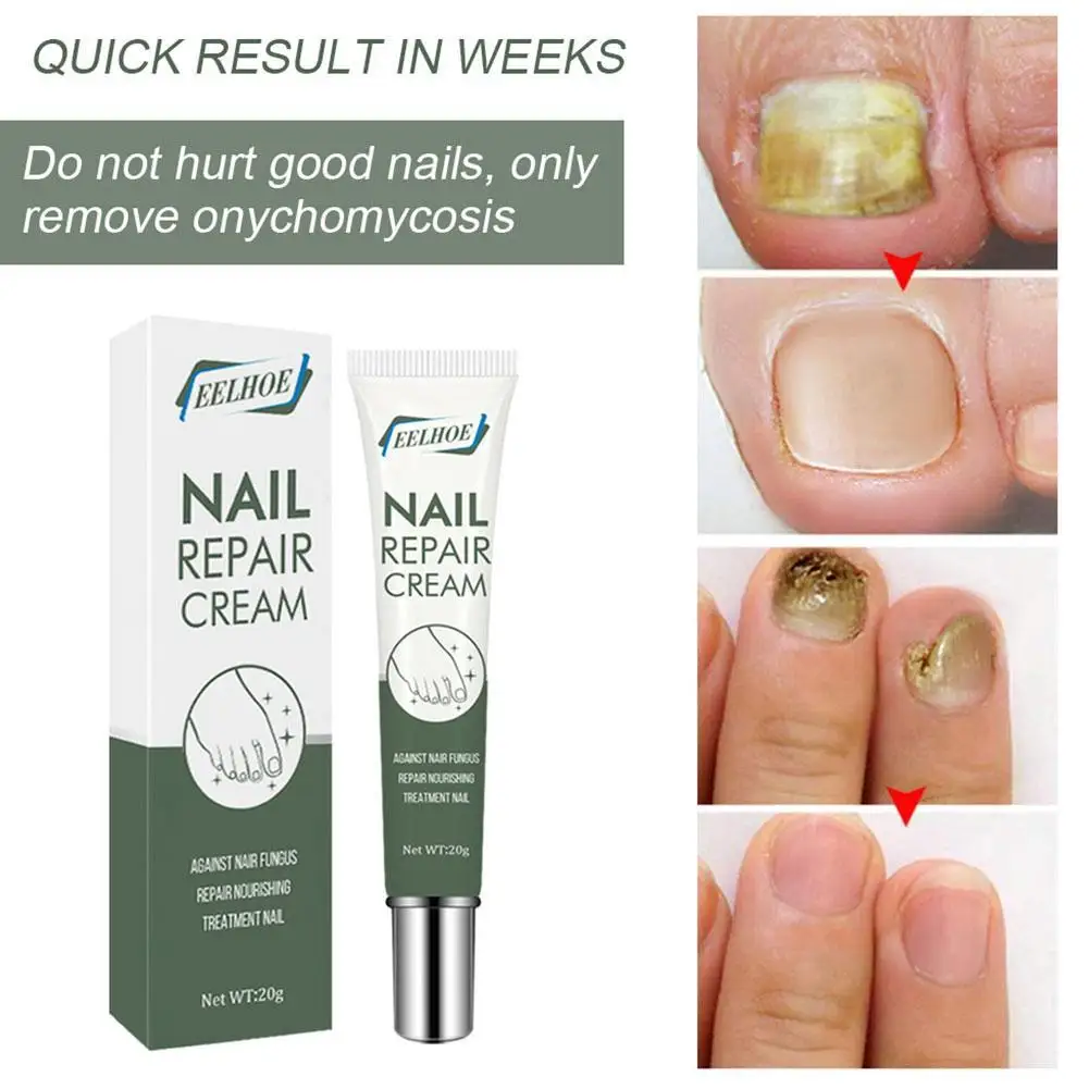 Fungal Nail Treatment Serum Nail Foot Nail Fungus Removal Gel Anti