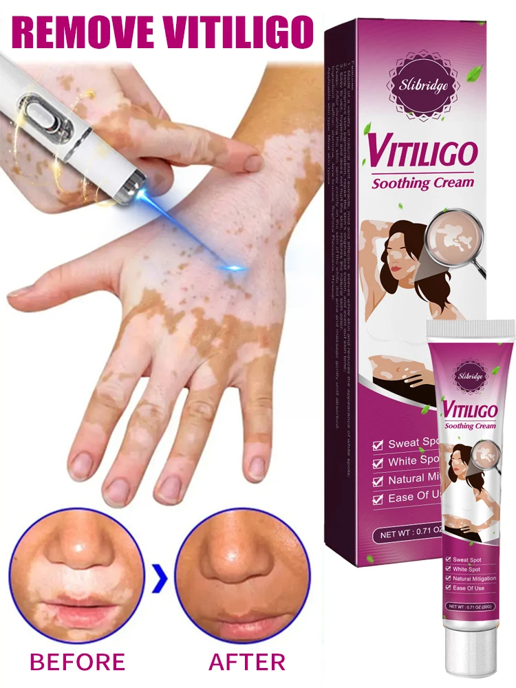 Improve vitiligo laser laser treatment