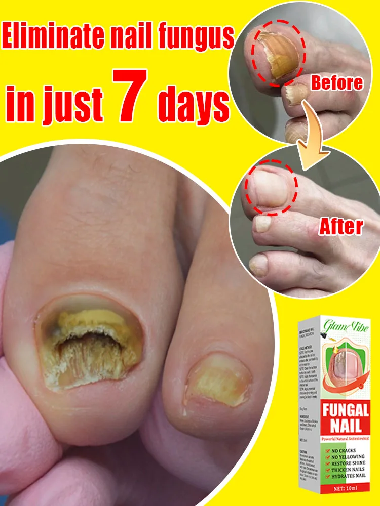 Fungus solution