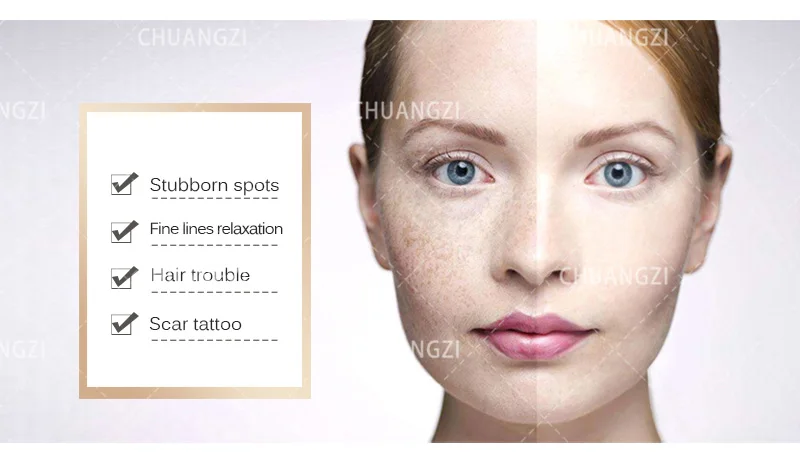 OPT 3-in-1-Gerät IPL Laser-Haarentfernung Pikosekunden-Tattoo-Pigmententfernung RF Anti-Aging-Handstück Eine Maschine Drei Anwendungen – Detail 10