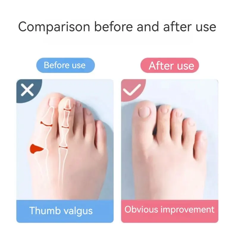 Toe Separators Toe Spreader Toe Corrector Finger Toe Separator Toe Protectors 2 Pairs Flexible Foot Orthotic Compact Exquisite Appearance Relief Curved Toes Overlapping Bunions Foot Care Tool