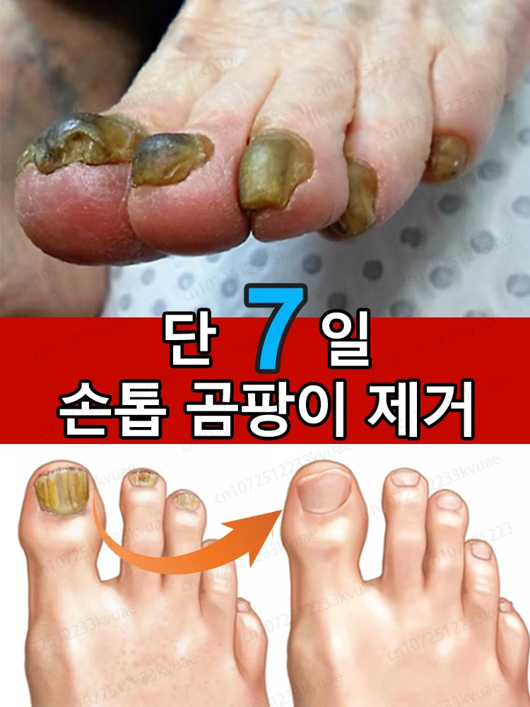 Aceite Esencial para tratamiento de hongos en las unas, suero para la eliminacion de hongos en los pies, 7 dias de r