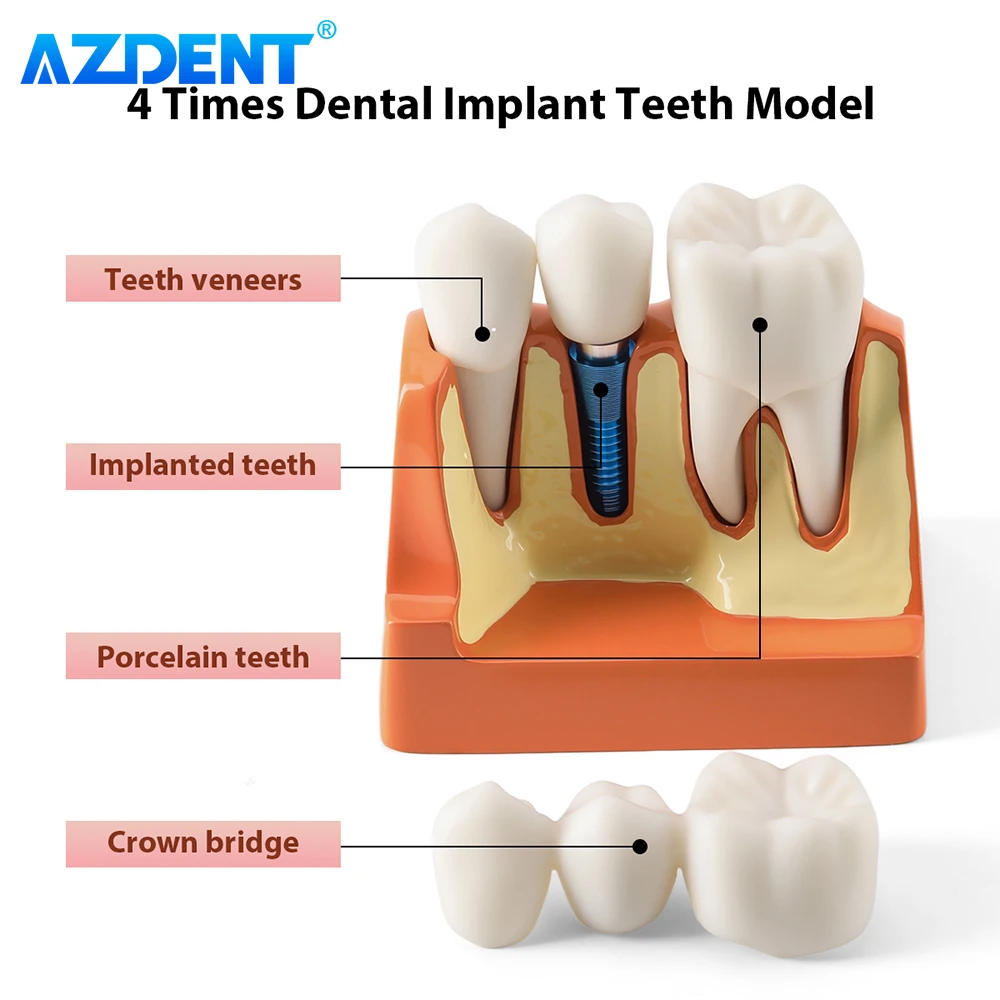 AZDENT 치과 4 배 치아 모델 임플란트 분석 크라운 브리지 데모 이동식 치과 연구 훈련 교육 모델