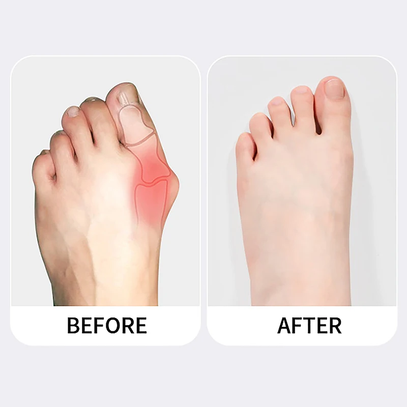 

1 шт., ортопедические носки для большого пальца ноги, при вальгусной деформации