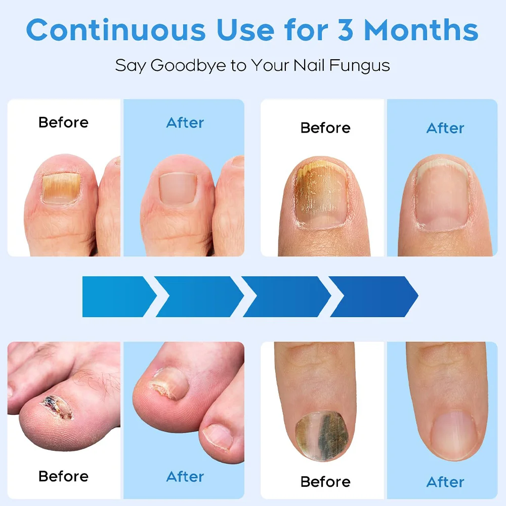 Nail Fungus Remover Personal Health Care Laser Therapy Pen Fungal Nail Laser Device Repair Fast Nails Fungus Onychomycosis Repair Toenail Fingernail Removes Nail Fungus Foot Care Device