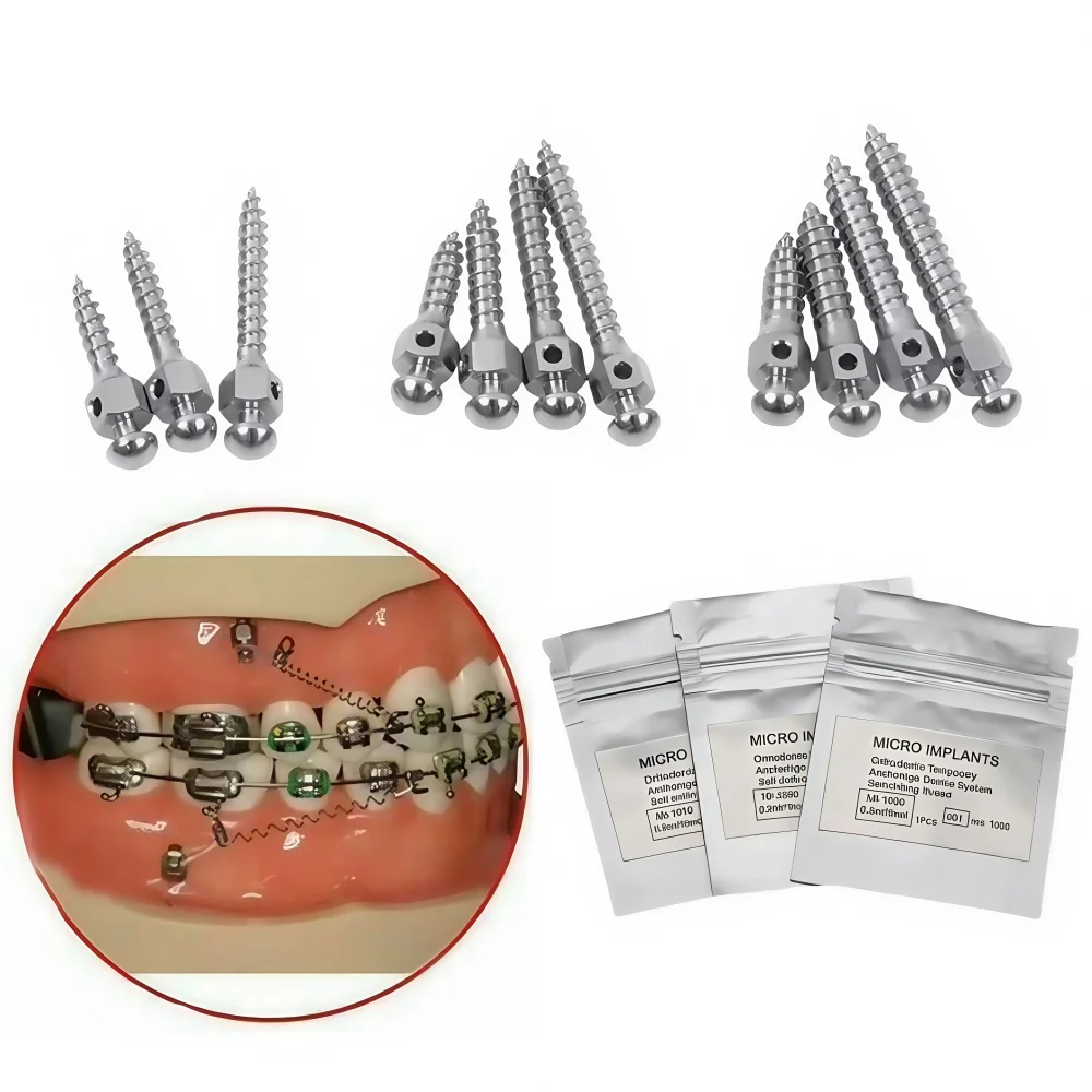 Mini Screw Invisalign Everything You Need to Know About Miniscrew Orthodontic and Its Uses in ...