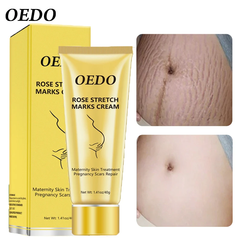cara menggunakan oedo rose remove stretch mark cream