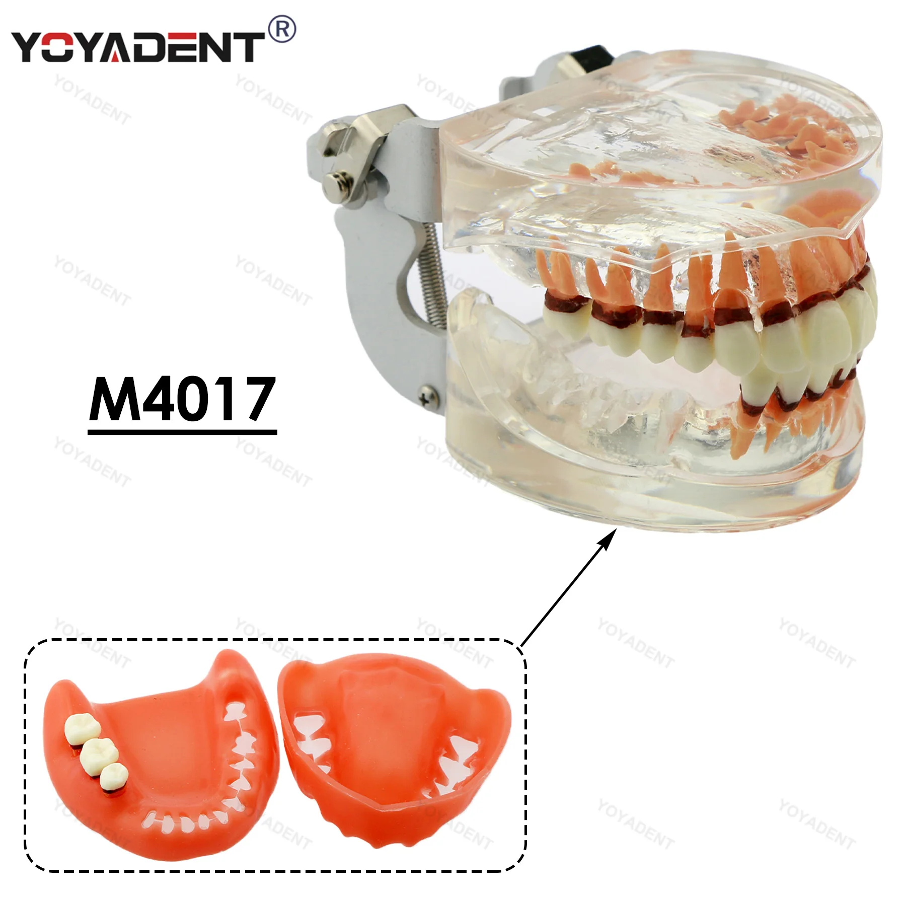 치과용 레진 모델 M4017 병리학 모델 치과 의사 시연 학습 환자 교육 시연 치주 질환 모델 치과 실험실