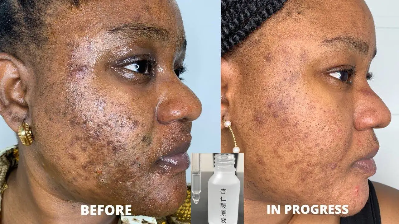 Mandelic Acid 20 Aha Alpha Hydroxy Peel For Rosacea Cystic Acne