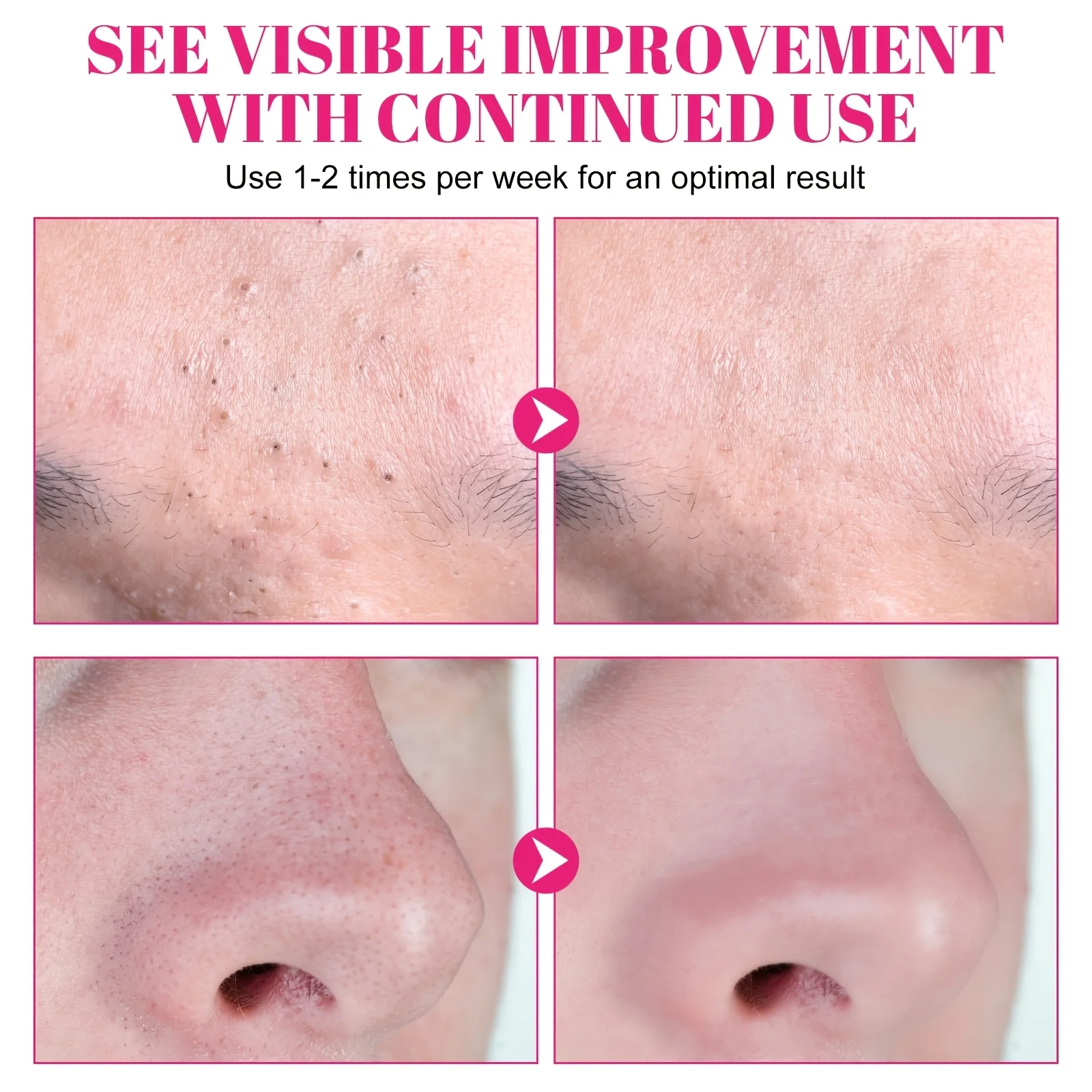 Description Picture 6 of itemUse 30 pieces of hydrocolloid nose strips to remove black and white heads and clean your nose