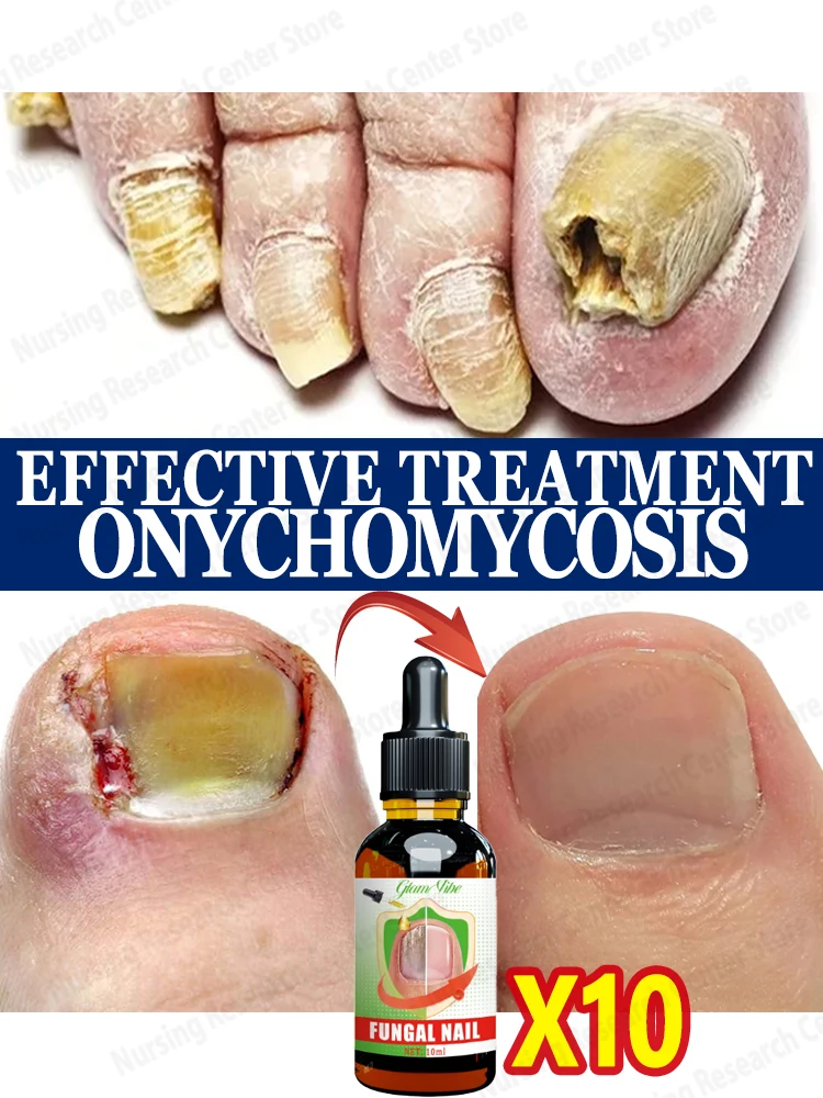 Eliminate nail problems